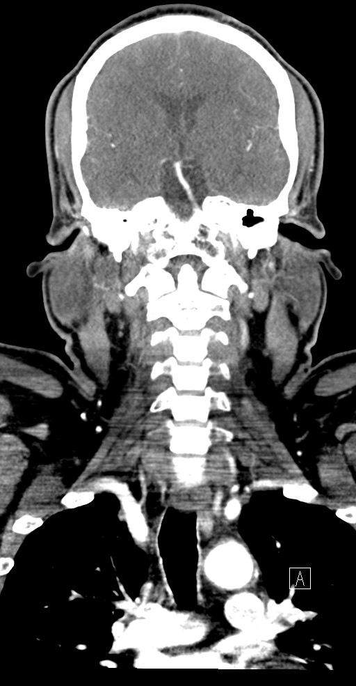 Isolated Primary Intraventricular Hemorrhage | Image | Radiopaedia.org