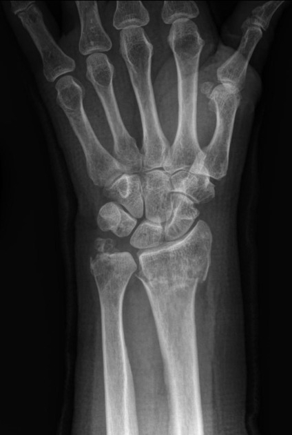 Colles fracture Radiology Reference Article Radiopaedia