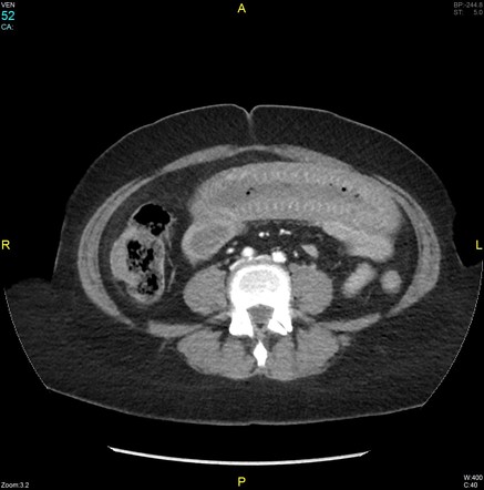 Stack of coins sign (bowel) | Radiology Reference Article | Radiopaedia.org