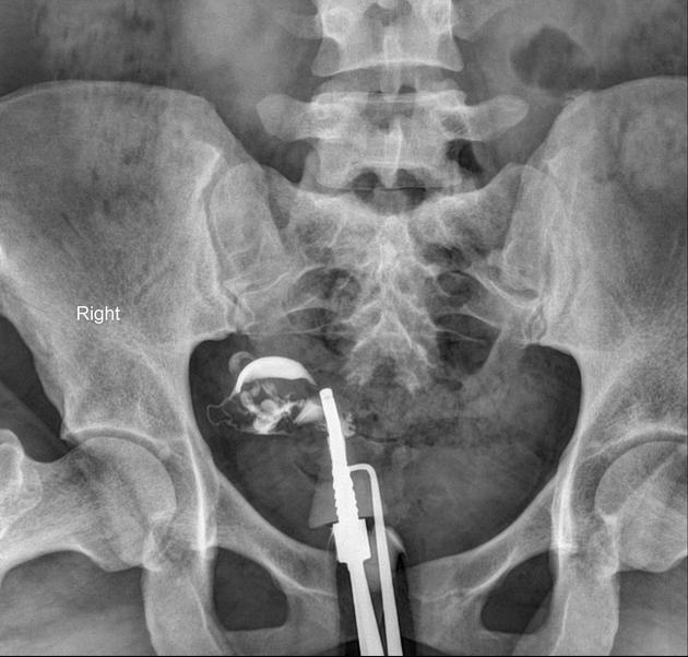 Unicornuate uterus | Radiology Reference Article | Radiopaedia.org