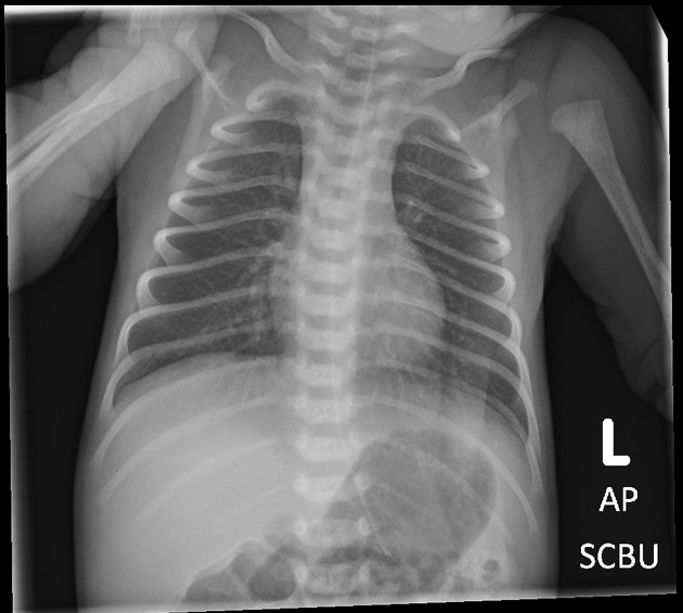 Normal Infant Chest Xray