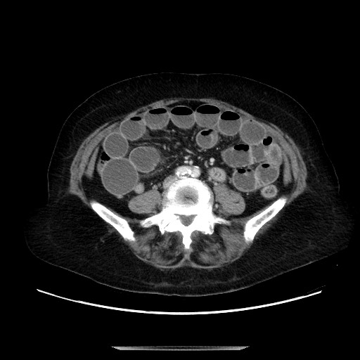 File:Small bowel obstruction, fecalization at the transition point ...