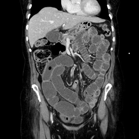 Small bowel obstruction, fecalization at the transition point ...