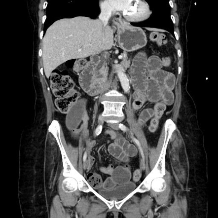 Small bowel obstruction, fecalization at the transition point | Image ...