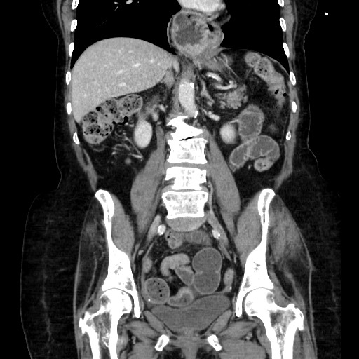 File:Small bowel obstruction, fecalization at the transition point ...