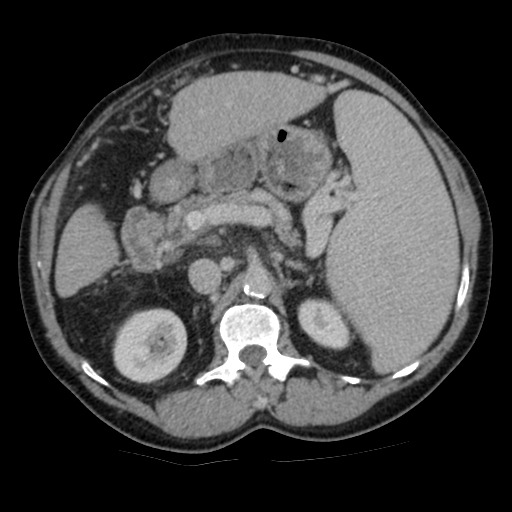 Upper abdominal lymphadenopathy - cirrhosis | Image | Radiopaedia.org