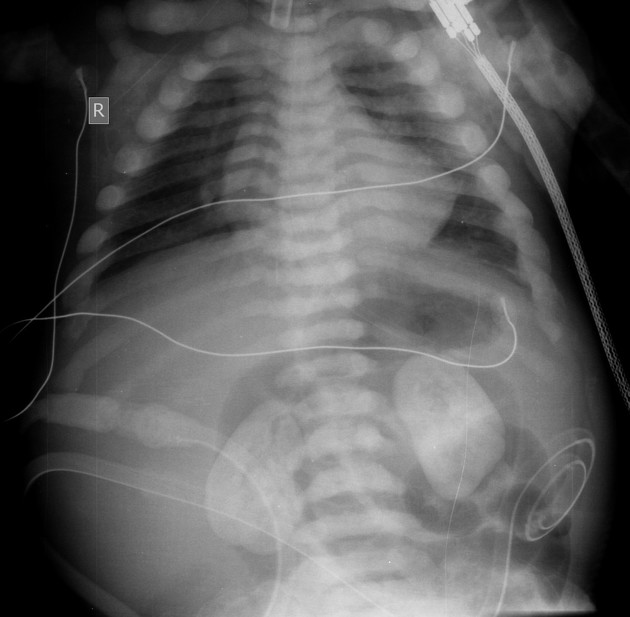 Medullary nephrocalcinosis | Radiology Reference Article | Radiopaedia.org