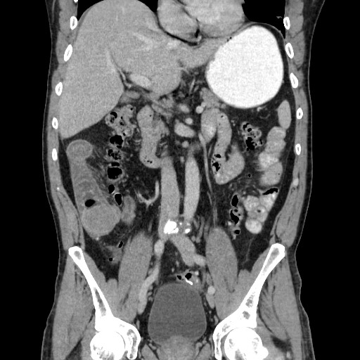 Small bowel desmoid tumor | Image | Radiopaedia.org