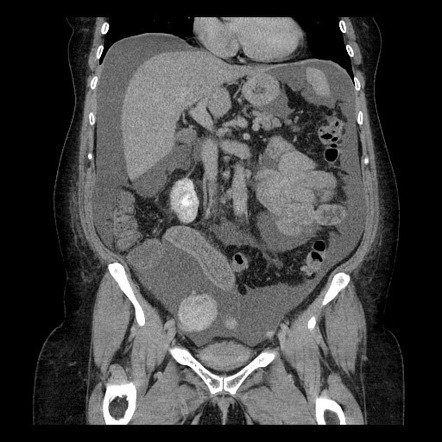 Eosinophilic gastroenteritis | Image | Radiopaedia.org