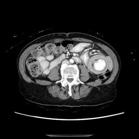 Intussusception | Radiology Reference Article | Radiopaedia.org