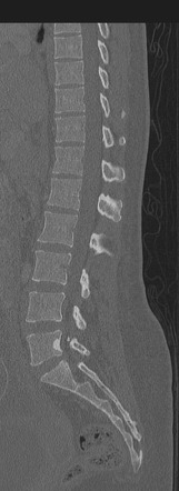 Possible traumatic placental abruption on CT | Image | Radiopaedia.org