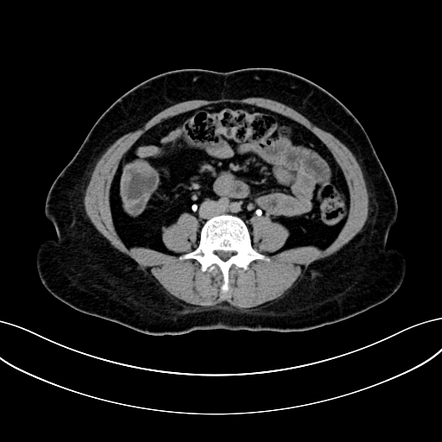 Adrenocortical carcinoma | Image | Radiopaedia.org