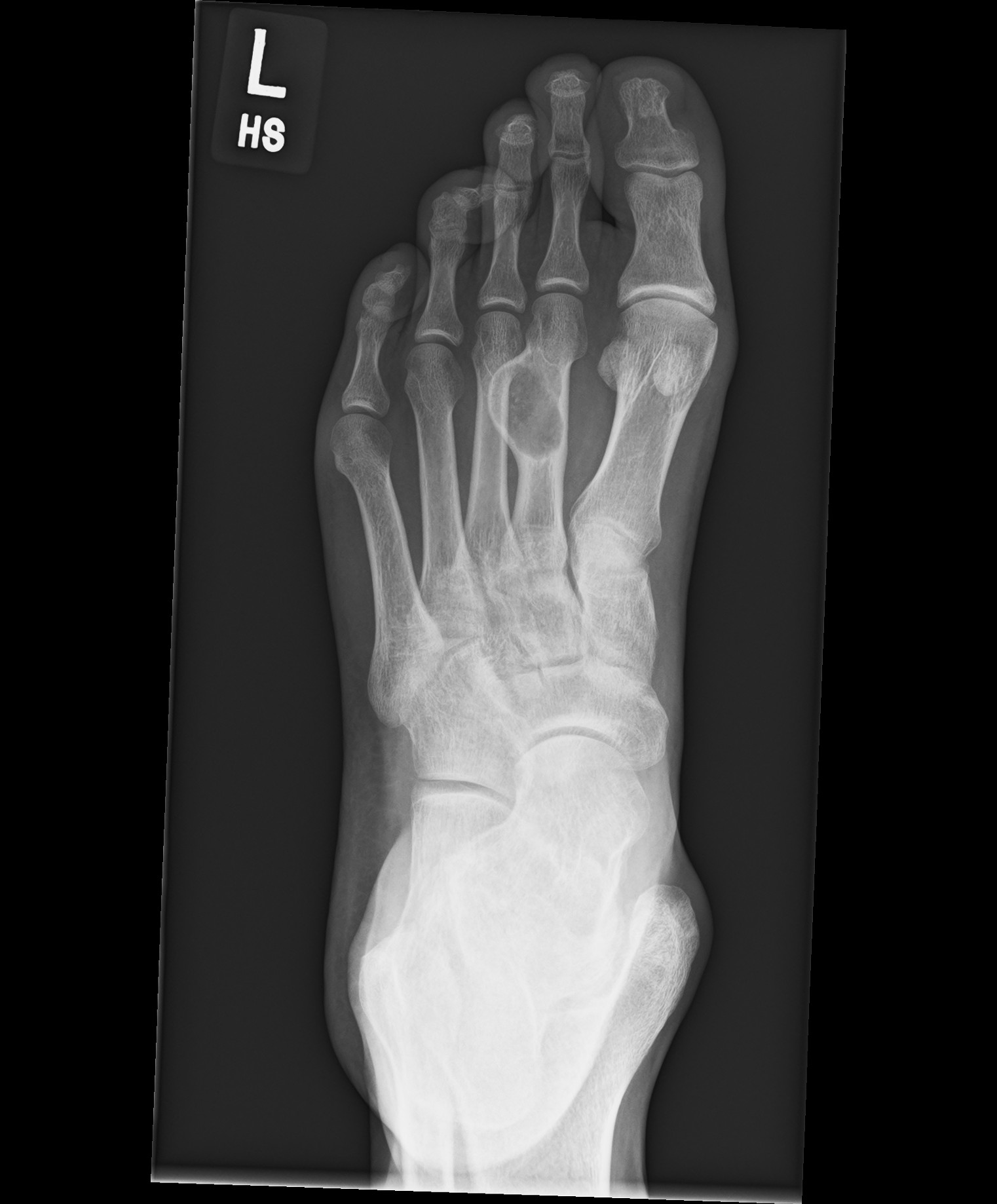 Metatarsal enchondroma | Image | Radiopaedia.org