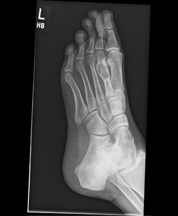 Metatarsal enchondroma | Image | Radiopaedia.org