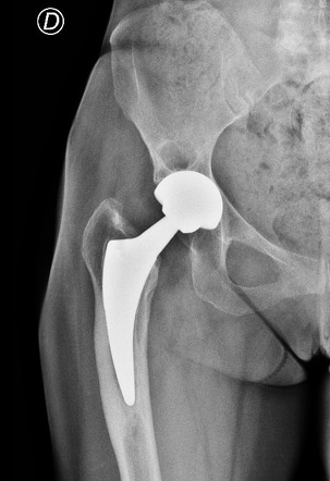 left total hip replacment icd 10