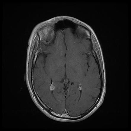 Sturge-Weber syndrome | Image | Radiopaedia.org