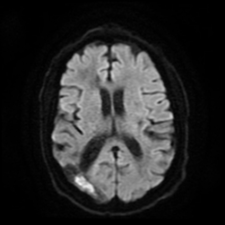 Mixed lobar and deep cerebral microbleeds | Image | Radiopaedia.org