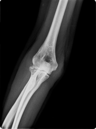 Radial head fracture-dislocation | Image | Radiopaedia.org