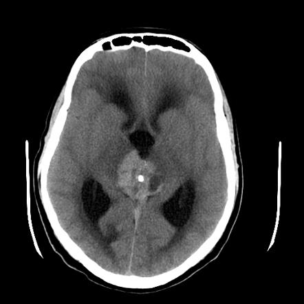 Germinoma | Radiology Reference Article | Radiopaedia.org