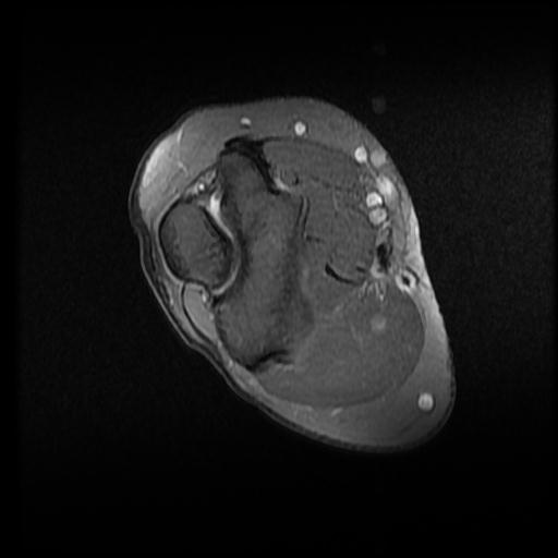 Lateral epicondylitis | Image | Radiopaedia.org