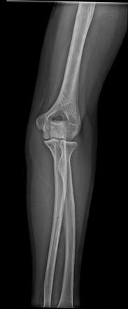 Isolated ulna shaft fracture | Radiology Case | Radiopaedia.org