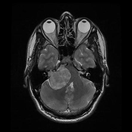 Vestibular schwannoma | Radiology Reference Article | Radiopaedia.org