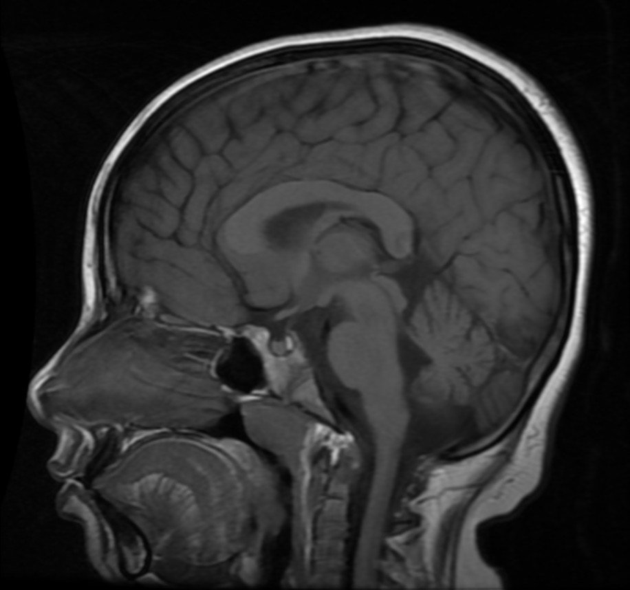 Neurodegeneration with brain iron accumulation | Image | Radiopaedia.org