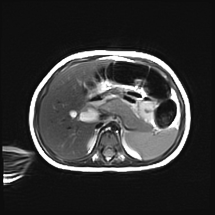 Choledochal cyst type 1A | Image | Radiopaedia.org