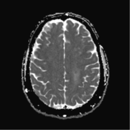 Non-ischemic cerebral enhancing (NICE) lesions - foreign body granuloma ...