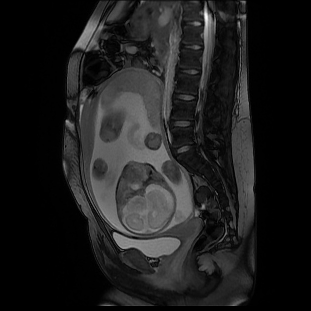 Pyelonephritis During Pregnancy