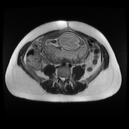 Acute appendicitis in pregnancy (MRI) | Radiology Case | Radiopaedia.org