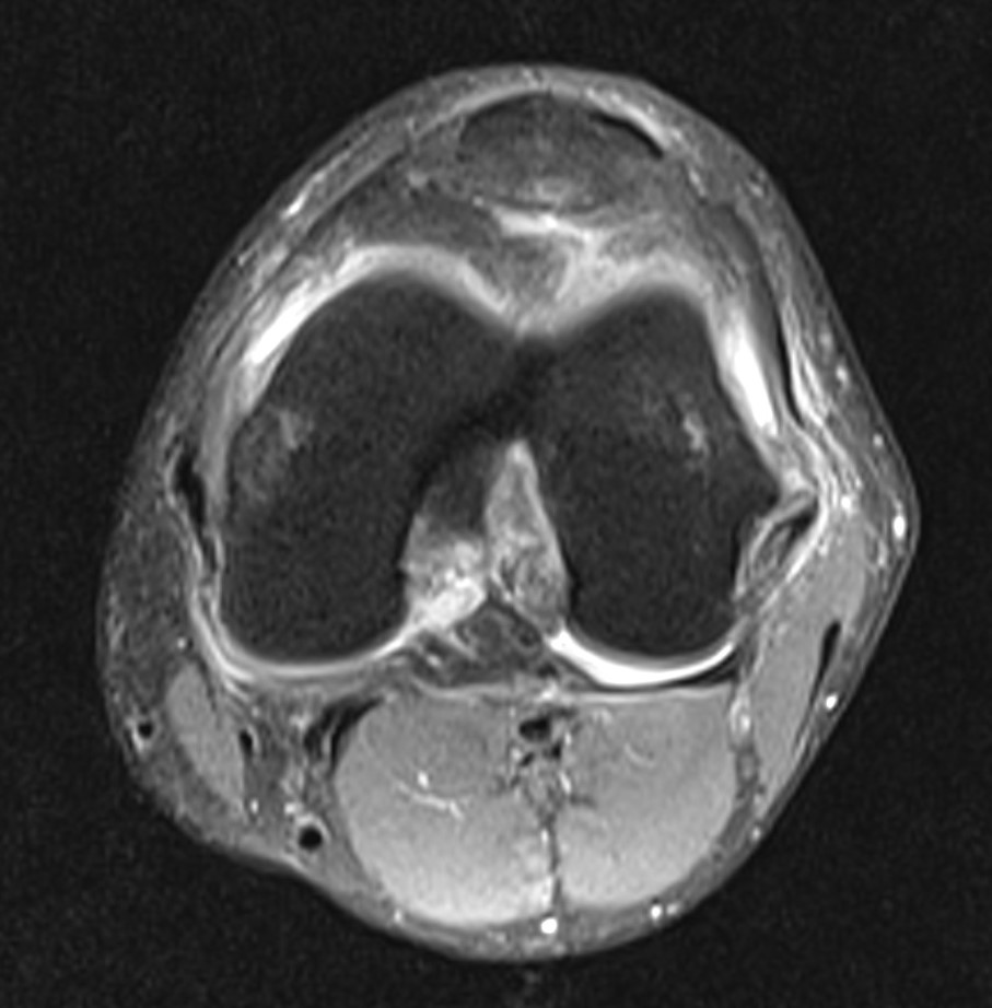 ACL tear, Wrisberg rip and posterolateral corner injury | Image ...