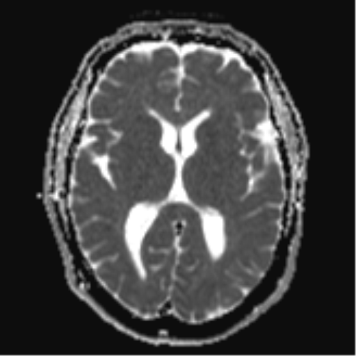 Quadrigeminal cistern lipoma | Image | Radiopaedia.org