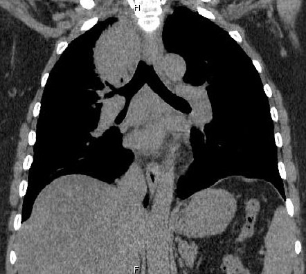 Lung cancer | Radiology Reference Article | Radiopaedia.org