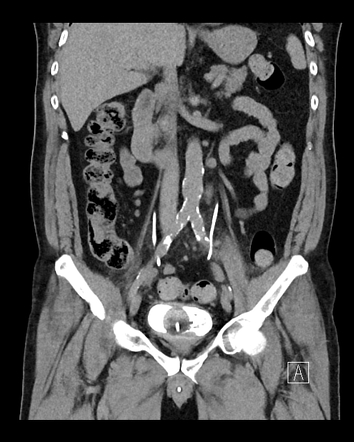 Small cell carcinoma of the prostate | Image | Radiopaedia.org