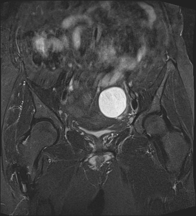 Adnexal multilocular cyst (O-RADS US 3/ O-RADS MRI 3) | Image ...