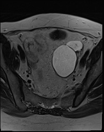 Ovarian Adnexal Reporting And Data System Magnetic Resonance Imaging O