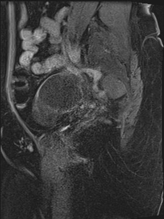 Adnexal multilocular cyst (O-RADS US 3/ O-RADS MRI 3) | Image ...