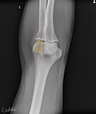 Radiocapitellar line | Radiology Reference Article | Radiopaedia.org