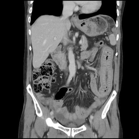 Submucosal jejunal hematoma with hemoperitoneum | Radiology Case ...