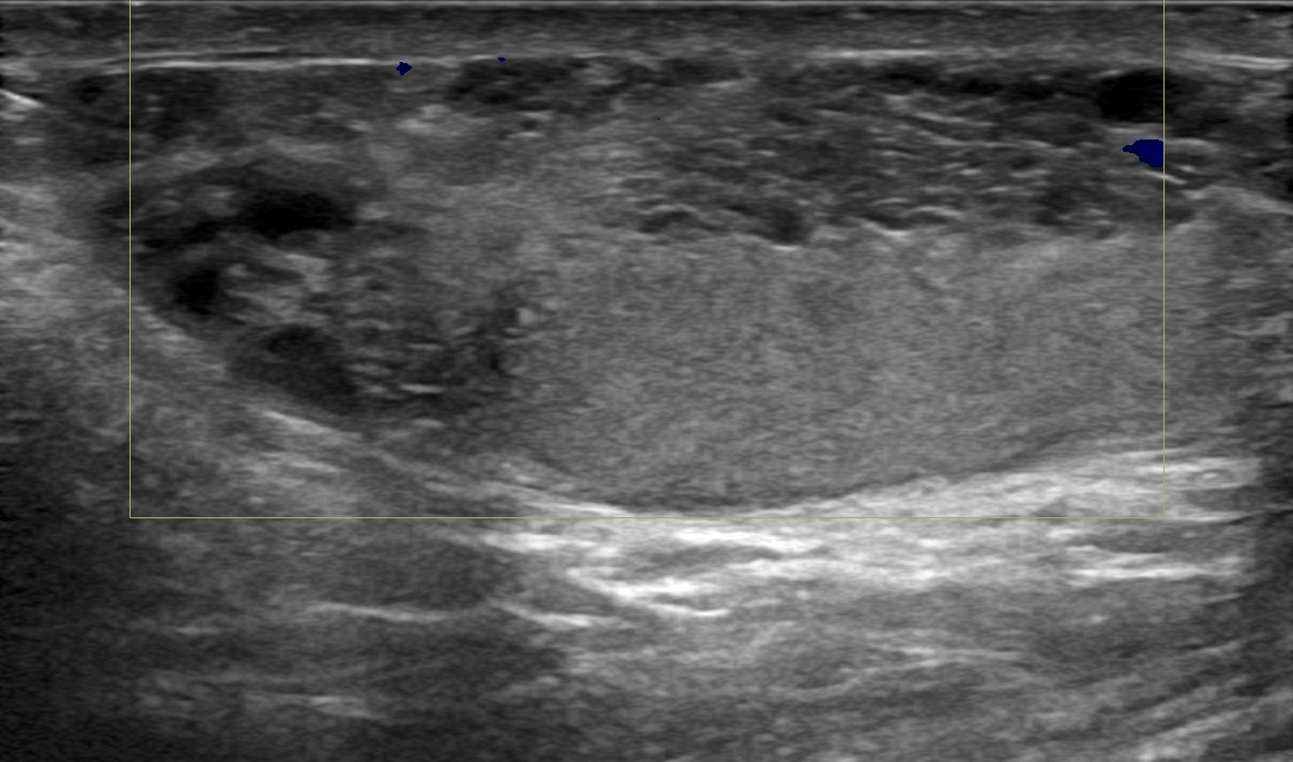 Ipsilateral Seminal Vesicle And Renal Agenesis Image Radiopaedia Org