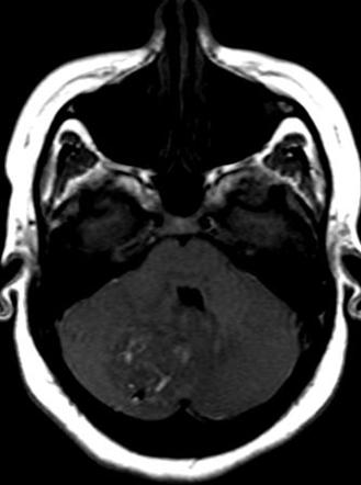 Cerebellar hemangioblastoma | Radiology Case | Radiopaedia.org