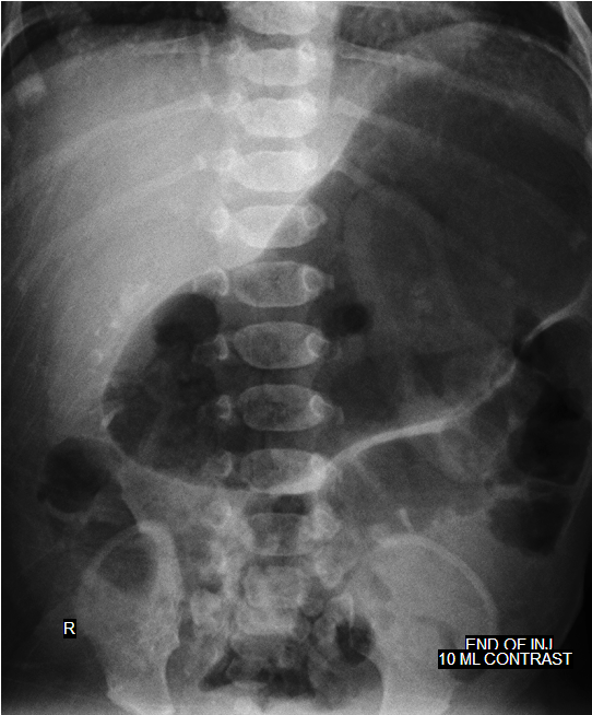 Megacalycosis | Image | Radiopaedia.org