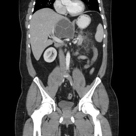 Hepatic Hydatid Cyst With Acute Pancreatitis 