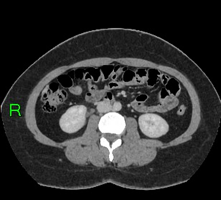 Escherichia coli urinary tract infection | Radiology Case | Radiopaedia.org