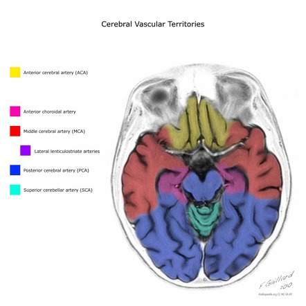 Brain arterial vascular territories | Radiology Reference Article ...