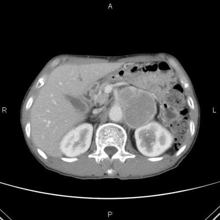 Retroperitoneal paraganglioma | Radiology Case | Radiopaedia.org