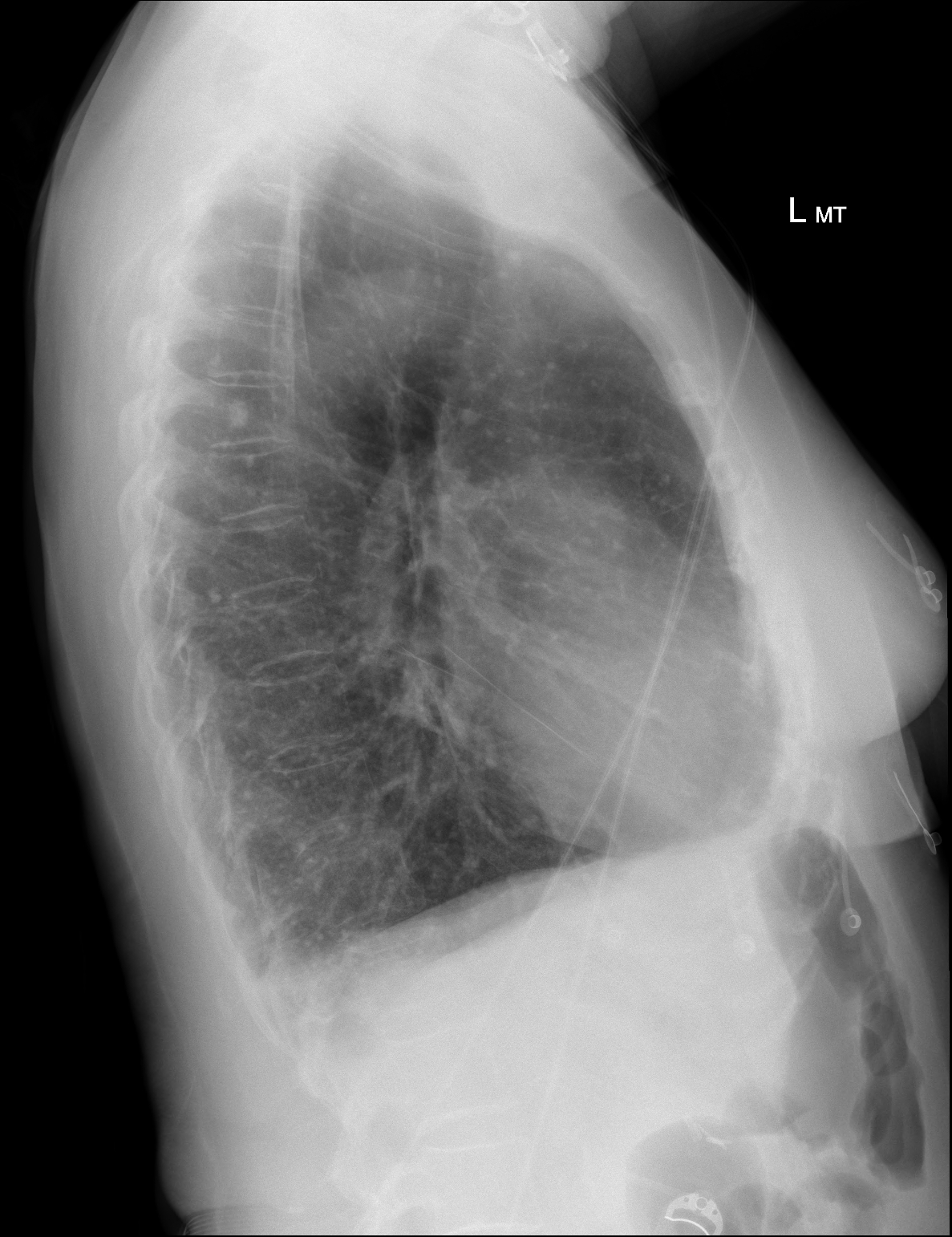 PA And Lateral Chest X Ray