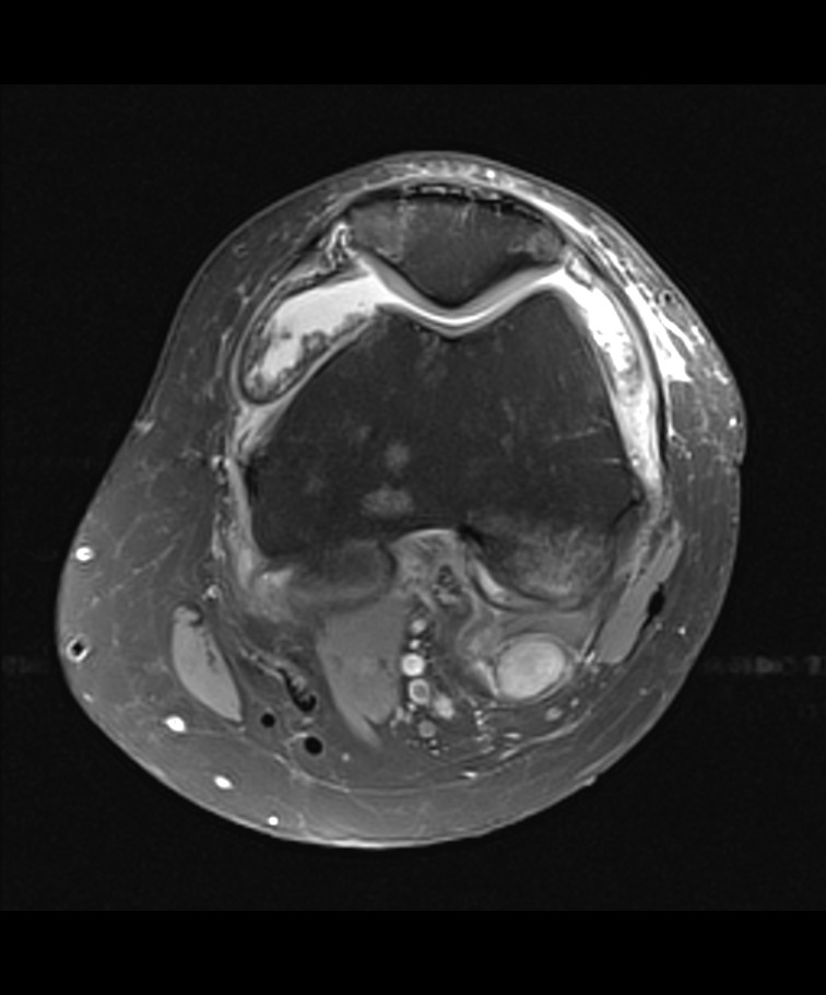 Tenosynovial giant cell tumor | Image | Radiopaedia.org