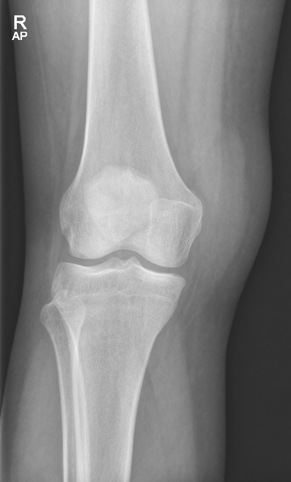 Prepatellar bursitis | Image | Radiopaedia.org